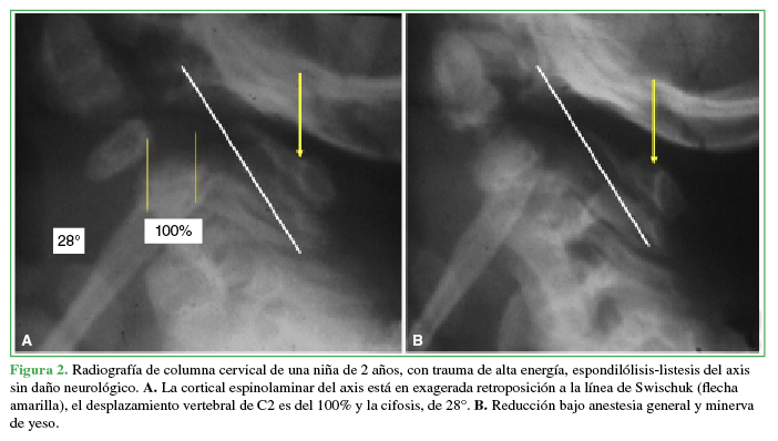 Radiografía de columna cervical de una niña de 2 años, con trauma de alta energía, espondilólisis-listesis del axis sin daño neurológico. A. La cortical espinolaminar del axis está en exagerada retroposición a la línea de Swischuk (flecha amarilla), el desplazamiento vertebral de C2 es del 100% y la cifosis, de 28°. B. Reducción bajo anestesia general y minerva de yeso.