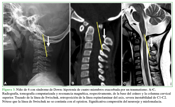 Niño de 6 con síndrome de Down: hipotonía de cuatro miembros exacerbada por un traumatismo. A-C. Radiografía, tomografía computarizada y resonancia magnética, respectivamente, de la base del cráneo y la columna cervical superior. Trazado de la línea de Swischuk, retroposición de la línea espinolaminar del axis, severa inestabilidad de C1-C2. Nótese que la línea de Swischuk no se continúa con el opistion. Significativa compresión del neuroeje y mielomalacia