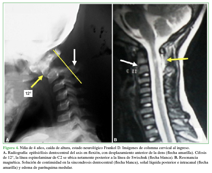 Niña de 4 años, caída de altura, estado neurológico Frankel D. Imágenes de columna cervical al ingreso. A. Radiografía: epifisiólisis dentocentral del axis en flexión, con desplazamiento anterior de la dens (flecha amarilla). Cifosis de 12°, la línea espinolaminar de C2 se ubica netamente posterior a la línea de Swischuk (flecha blanca). B. Resonancia magnética. Solución de continuidad en la sincondrosis dentocentral (flecha blanca), señal líquida posterior e intracanal (flecha amarilla) y edema de parénquima medular.