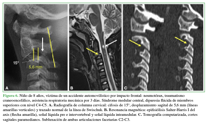 Niño de 8 años, víctima de un accidente automovilístico por impacto frontal: neumotórax, traumatismo craneoencefálico, asistencia respiratoria mecánica por 3 días. Síndrome medular central, diparesia flácida de miembros superiores con nivel C4-C5. A. Radiografía de columna cervical: cifosis de 15°, desplazamiento sagital de 5,6 mm (líneas amarillas verticales) y trazado normal de la línea de Swischuk. B. Resonancia magnética: epifisiólisis Salter-Harris I del axis (flecha amarilla), señal líquida pre e intervertebral y señal líquida intramedular. C. Tomografía computarizada, cortes sagitales paramedianos. Subluxación de ambas articulaciones facetarias C2-C3.