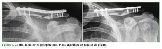 Control radiológico posoperatorio. Placa anatómica en función de puente.