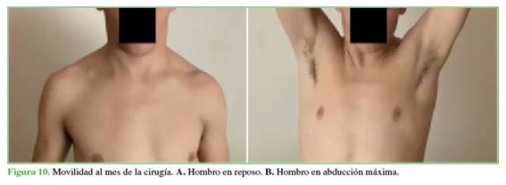 Movilidad al mes de la cirugía. A. Hombro en reposo. B. Hombro en abducción máxima.