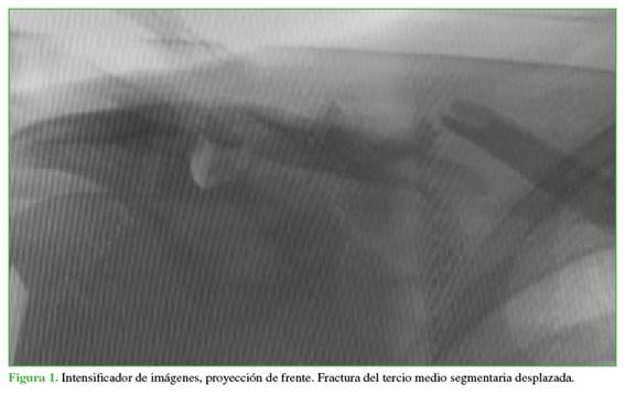 Intensificador de imágenes, proyección de frente. Fractura del tercio medio segmentaria desplazada.