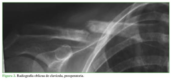Radiografía oblicua de clavícula, preoperatoria.