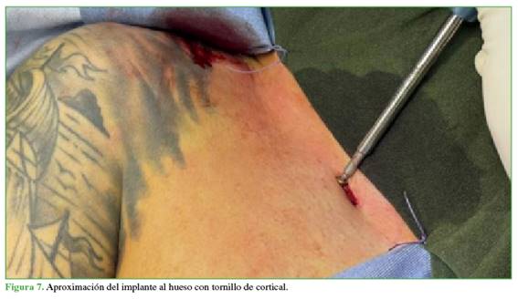 Aproximación del implante al hueso con tornillo de cortical.