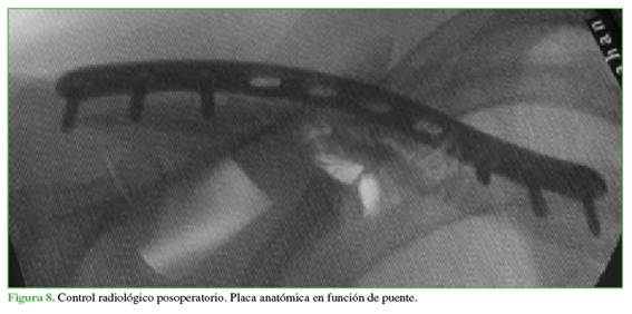 Control radiológico posoperatorio. Placa anatómica en función de puente.