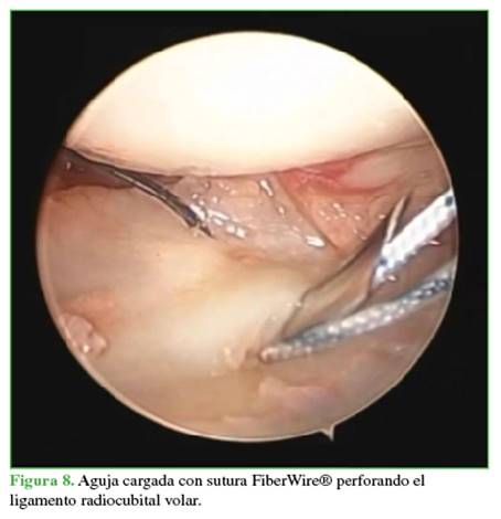 Aguja cargada con sutura FiberWire® perforando el ligamento radiocubital volar.