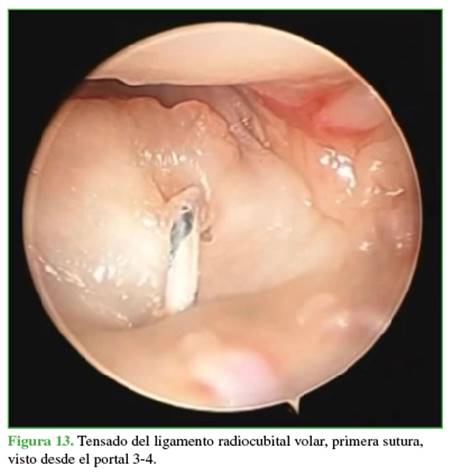 Tensado del ligamento radiocubital volar, primera sutura, visto desde el portal 3-4.