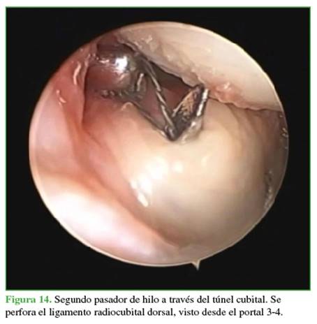 Segundo pasador de hilo a través del túnel cubital. Se perfora el ligamento radiocubital dorsal, visto desde el portal 3-4.