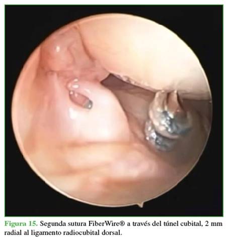 Segunda sutura FiberWire® a través del túnel cubital, 2 mm radial al ligamento radiocubital dorsal.