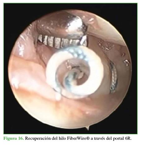 Recuperación del hilo FiberWire® a través del portal 6R.