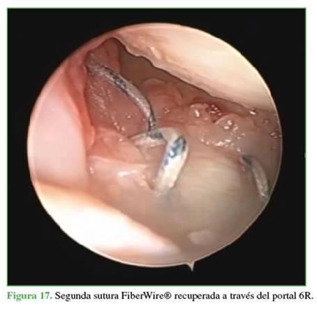 Segunda sutura FiberWire® recuperada a través del portal 6R.