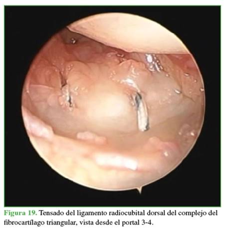 Tensado del ligamento radiocubital dorsal del complejo del fibrocartílago triangular, vista desde el portal 3-4.