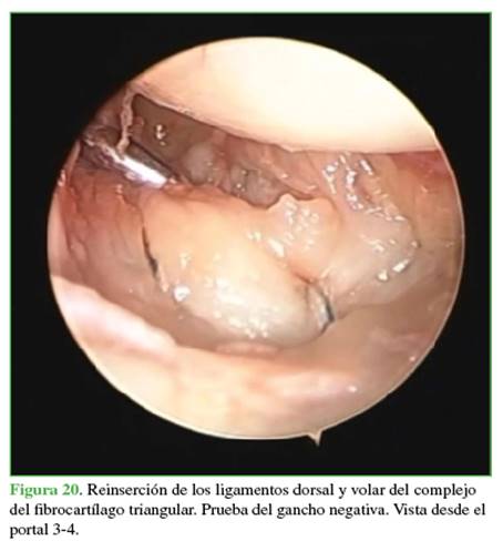 Reinserción de los ligamentos dorsal y volar del complejo del fibrocartílago triangular. Prueba del gancho negativa. Vista desde el portal 3-4.