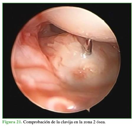 Comprobación de la clavija en la zona 2 ósea.