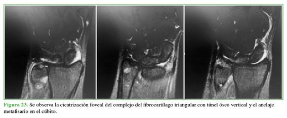 Se observa la cicatrización foveal del complejo del fibrocartílago triangular con túnel óseo vertical y el anclaje metafisario en el cúbito.