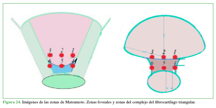 Imágenes de las zonas de Matsumoto. Zonas foveales y zonas del complejo del fibrocartílago triangular.
