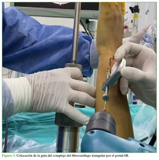 Colocación de la guía del complejo del fibrocartílago triangular por el portal 6R.