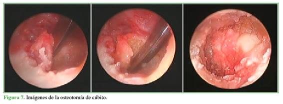 Imágenes de la osteotomía de cúbito.