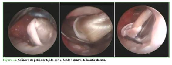 Cilindro de poliéster tejido con el tendón dentro de la articulación.