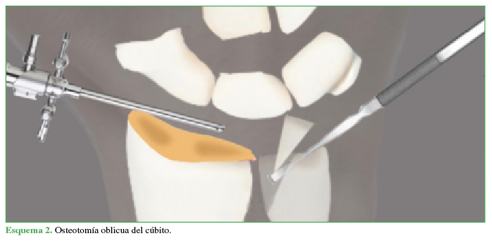 Osteotomía oblicua del cúbito.