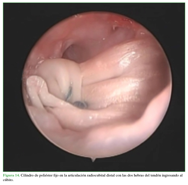 Cilindro de poliéster fijo en la articulación radiocubital distal con las dos hebras del tendón ingresando al cúbito.