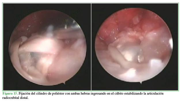 Fijación del cilindro de poliéster con ambas hebras ingresando en el cúbito estabilizando la articulación radiocubital distal.