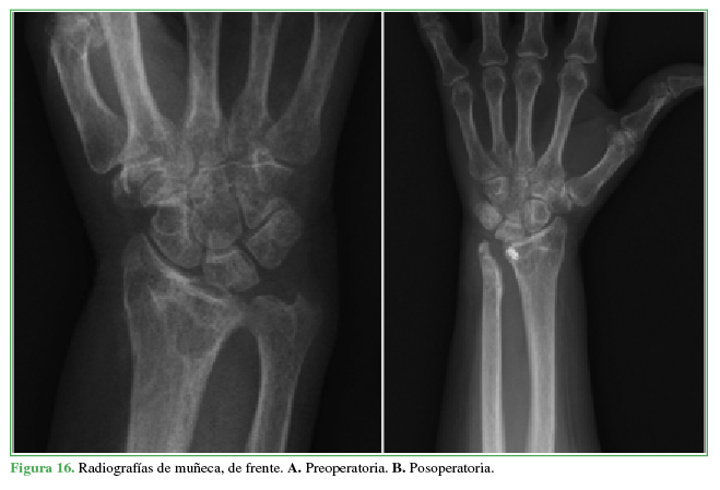 Radiografías de muñeca, de frente. A. Preoperatoria. B. Posoperatoria.