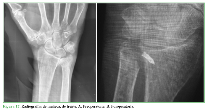 Radiografías de muñeca, de frente. A. Preoperatoria. B. Posoperatoria.