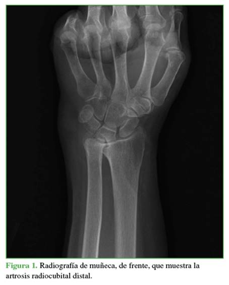 Radiografía de muñeca, de frente, que muestra la artrosis radiocubital distal.