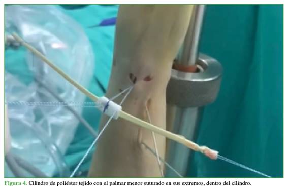 Cilindro de poliéster tejido con el palmar menor suturado en sus extremos, dentro del cilindro.