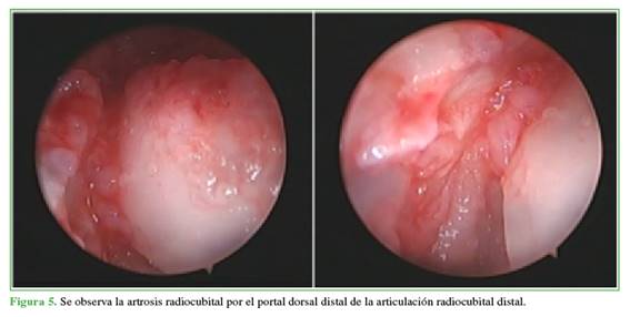 Se observa la artrosis radiocubital por el portal dorsal distal de la articulación radiocubital distal.