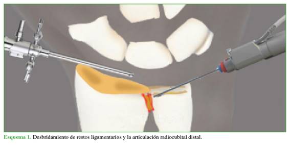 Desbridamiento de restos ligamentarios y la articulación radiocubital distal.