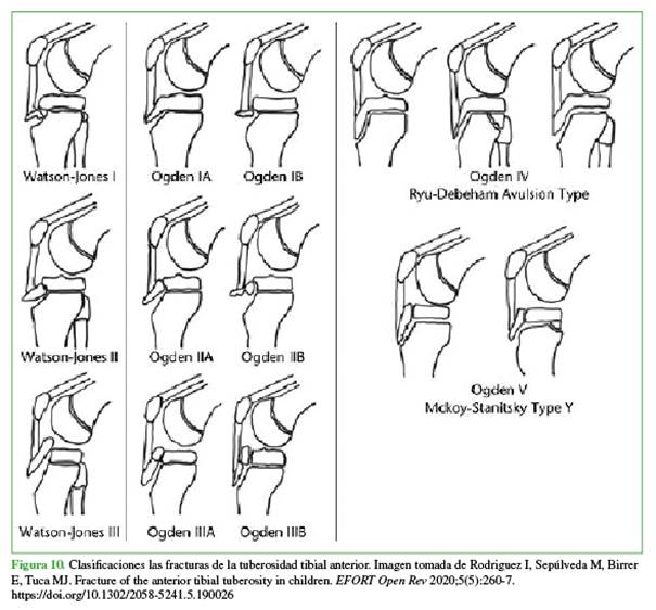 Clasificaciones las fracturas de la tuberosidad tibial anterior. Imagen tomada de Rodriguez I, Sepúlveda M, Birrer E, Tuca MJ. Fracture of the anterior tibial tuberosity in children. EFORT Open Rev 2020;5(5):260-7. https://doi.org/10.1302/2058-5241.5.190026
