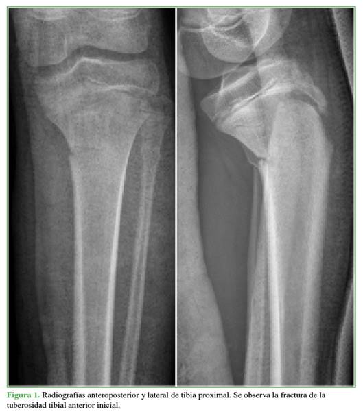 Radiografías anteroposterior y lateral de tibia proximal. Se observa la fractura de la tuberosidad tibial anterior inicial.