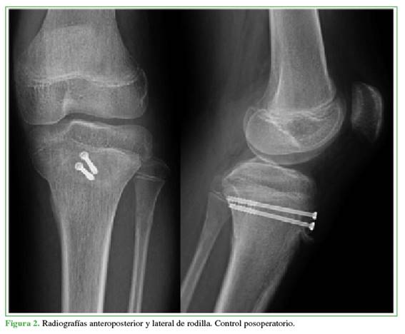 Radiografías anteroposterior y lateral de rodilla. Control posoperatorio.