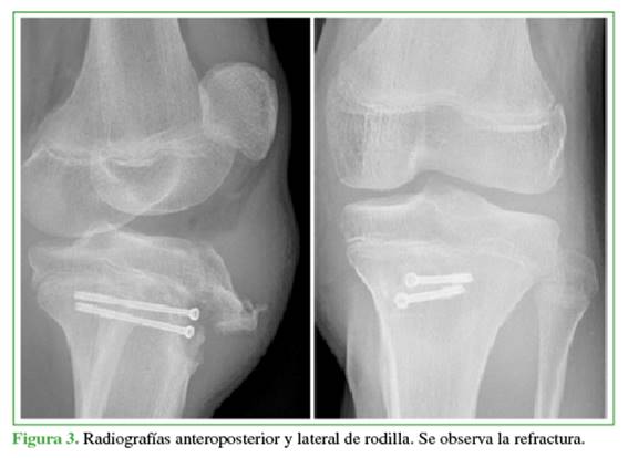 Radiografías anteroposterior y lateral de rodilla. Se observa la refractura.