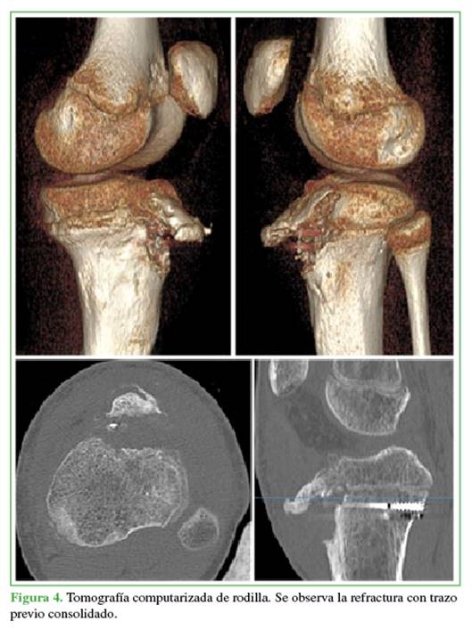 Tomografía computarizada de rodilla. Se observa la refractura con trazo previo consolidado.