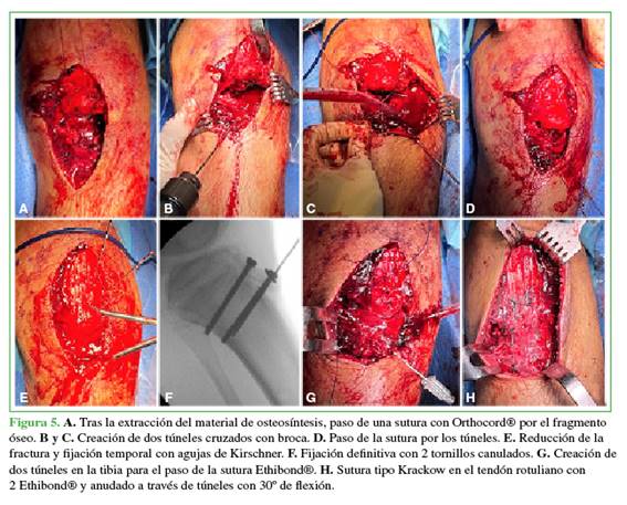 A. Tras la extracción del material de osteosíntesis, paso de una sutura con Orthocord® por el fragmento óseo. B y C. Creación de dos túneles cruzados con broca. D. Paso de la sutura por los túneles. E. Reducción de la fractura y fijación temporal con agujas de Kirschner. F. Fijación definitiva con 2 tornillos canulados. G. Creación de dos túneles en la tibia para el paso de la sutura Ethibond®. H. Sutura tipo Krackow en el tendón rotuliano con 2 Ethibond® y anudado a través de túneles con 30º de flexión.