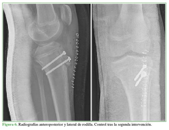 Radiografías anteroposterior y lateral de rodilla. Control tras la segunda intervención.