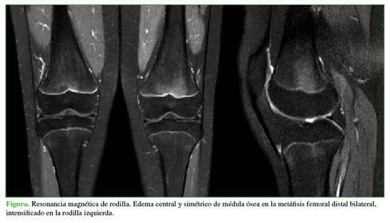 Resonancia magn&eacute;tica de rodilla. Edema central y sim&eacute;trico de m&eacute;dula &oacute;sea en la met&aacute;fisis femoral distal bilateral, intensificado en la rodilla izquierda.