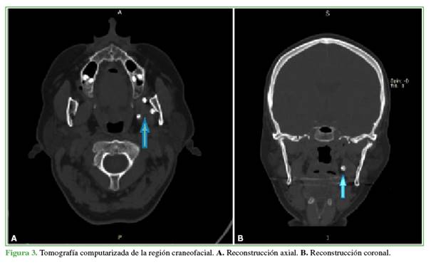 Tomografía computarizada de la región craneofacial. A. Reconstrucción axial. B. Reconstrucción coronal.