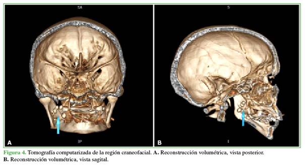 Tomografía computarizada de la región craneofacial. A. Reconstrucción volumétrica, vista posterior. B. Reconstrucción volumétrica, vista sagital.