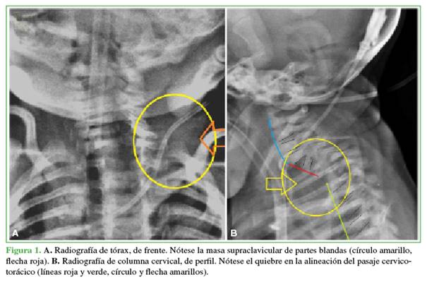  A. Radiograf&iacute;a de t&oacute;rax, de frente. N&oacute;tese la masa supraclavicular de partes blandas (c&iacute;rculo amarillo, flecha roja). B. Radiograf&iacute;a de columna cervical, de perfil. N&oacute;tese el quiebre en la alineaci&oacute;n del pasaje cervico-tor&aacute;cico (l&iacute;neas roja y verde, c&iacute;rculo y flecha amarillos).