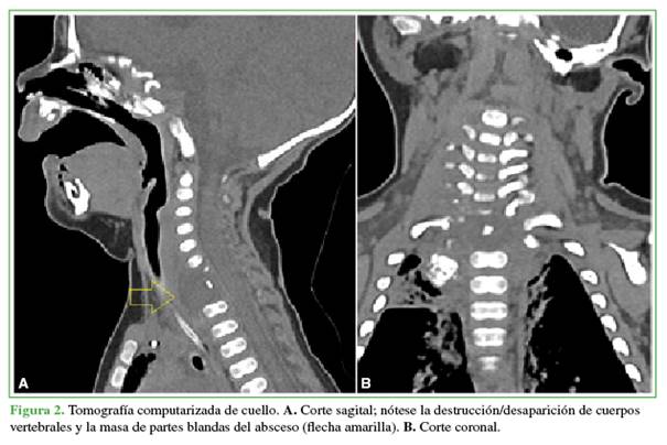 Tomograf&iacute;a computarizada de cuello. A. Corte sagital; n&oacute;tese la destrucci&oacute;n/desaparici&oacute;n de cuerpos vertebrales y la masa de partes blandas del absceso (flecha amarilla). B. Corte coronal.
