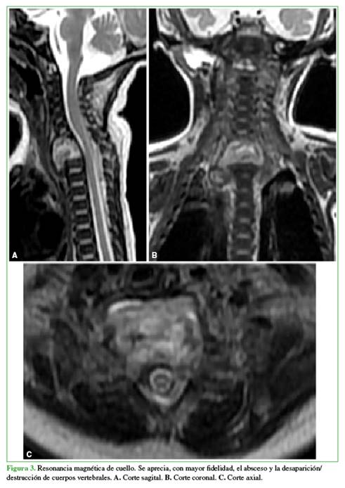 Resonancia magn&eacute;tica de cuello. Se aprecia, con mayor fidelidad, el absceso y la desaparici&oacute;n/ destrucci&oacute;n de cuerpos vertebrales. A. Corte sagital. B. Corte coronal. C. Corte axial.