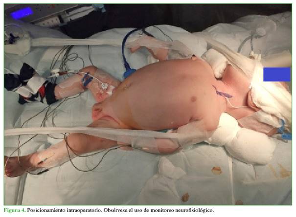 Posicionamiento intraoperatorio. Obs&eacute;rvese el uso de monitoreo neurofisiol&oacute;gico.