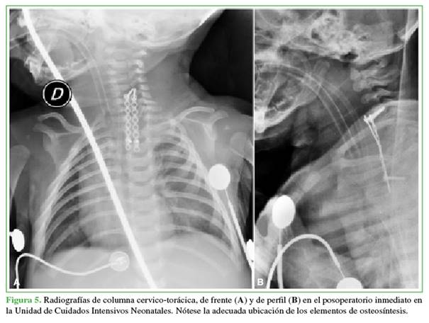 Radiograf&iacute;as de columna cervico-tor&aacute;cica, de frente (A) y de perfil (B) en el posoperatorio inmediato en la Unidad de Cuidados Intensivos Neonatales. N&oacute;tese la adecuada ubicaci&oacute;n de los elementos de osteos&iacute;ntesis.