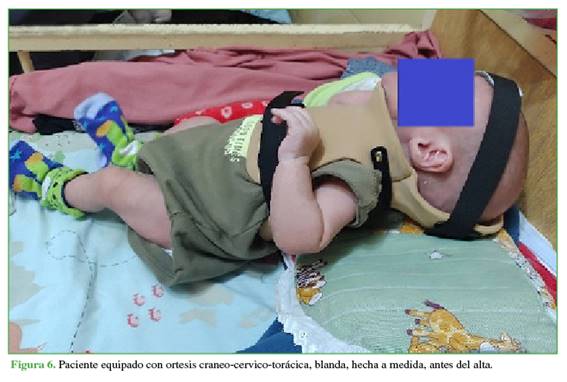 Paciente equipado con ortesis craneo-cervico-tor&aacute;cica, blanda, hecha a medida, antes del alta.