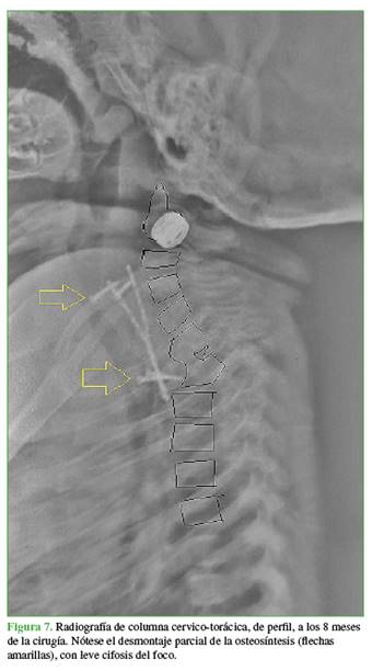 Radiograf&iacute;a de columna cervico-tor&aacute;cica, de perfil, a los 8 meses de la cirug&iacute;a. N&oacute;tese el desmontaje parcial de la osteos&iacute;ntesis (flechas amarillas), con leve cifosis del foco.